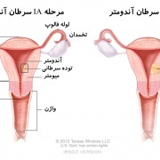 uterine-cancer